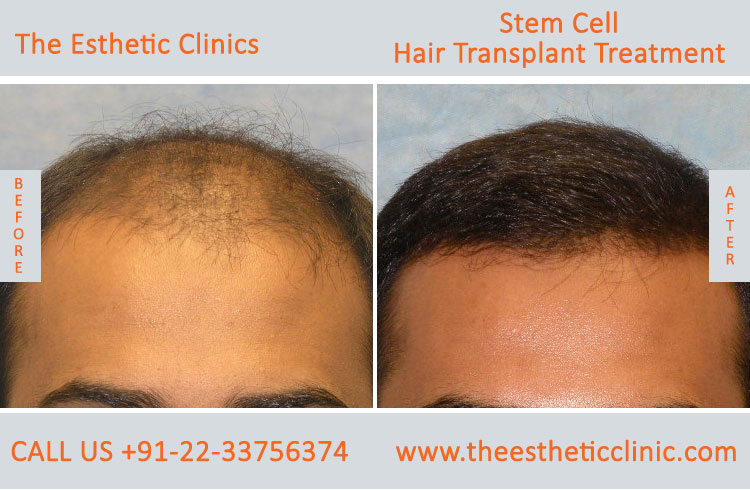 Stem Cell Hair Transplant Treatment before after photos in mumbai india (5)